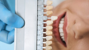 Почему свои зубы с желтизной лучше сверкающих виниров, рассказал стоматолог